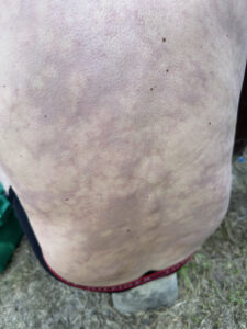 Mynd af baki manns sem er með köfunarveiki. Húðin verður eins og marmari,